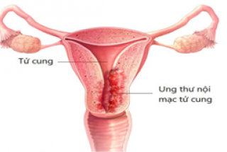 UNG THƯ NỘI MẠC TỬ CUNG